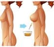 CCFP - La reconstruction mammaire par lipofilling