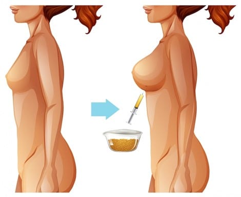 CCFP - La reconstruction mammaire par lipofilling