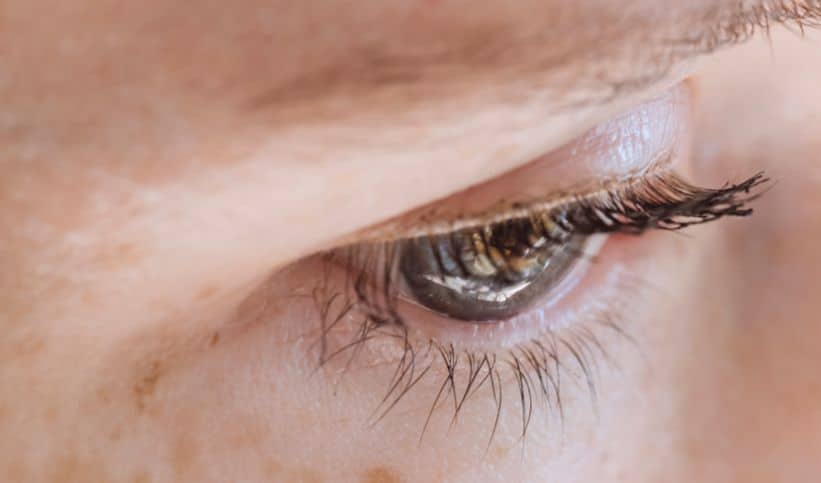 Taches pigmentaires et boutons